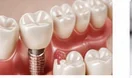 Dental Crowns