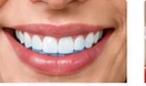 Teeth Whitening